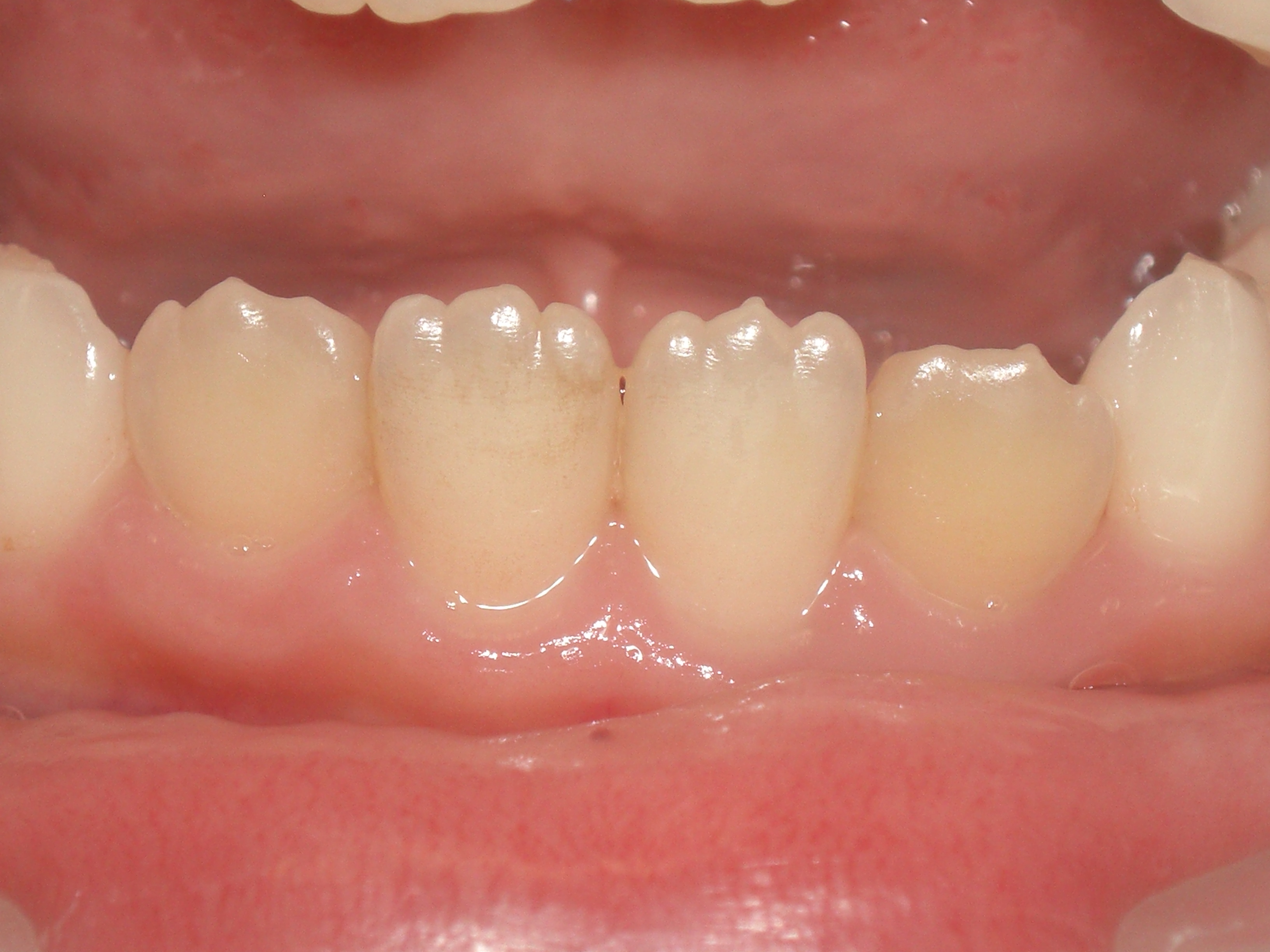 永久歯 生え 方 下 の 歯