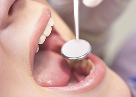 口腔内全体を考慮したインプラント治療